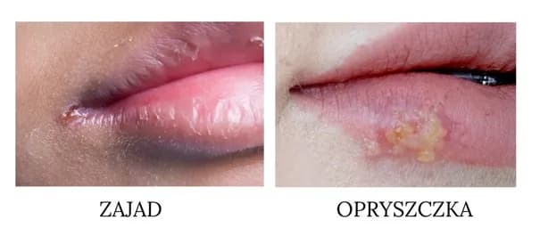 Zajady: Skuteczne leki, przyczyny i jak się ich pozbyć