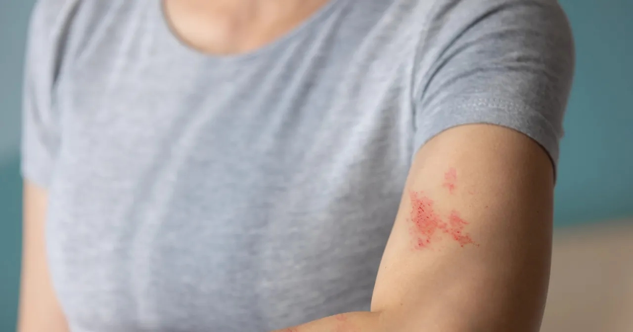 Jakie leki na półpasiec skutecznie łagodzą ból i przyspieszają leczenie