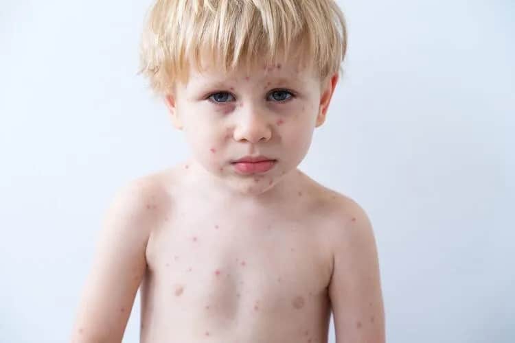 Jakie leki na bostonkę pomogą złagodzić objawy u dzieci?