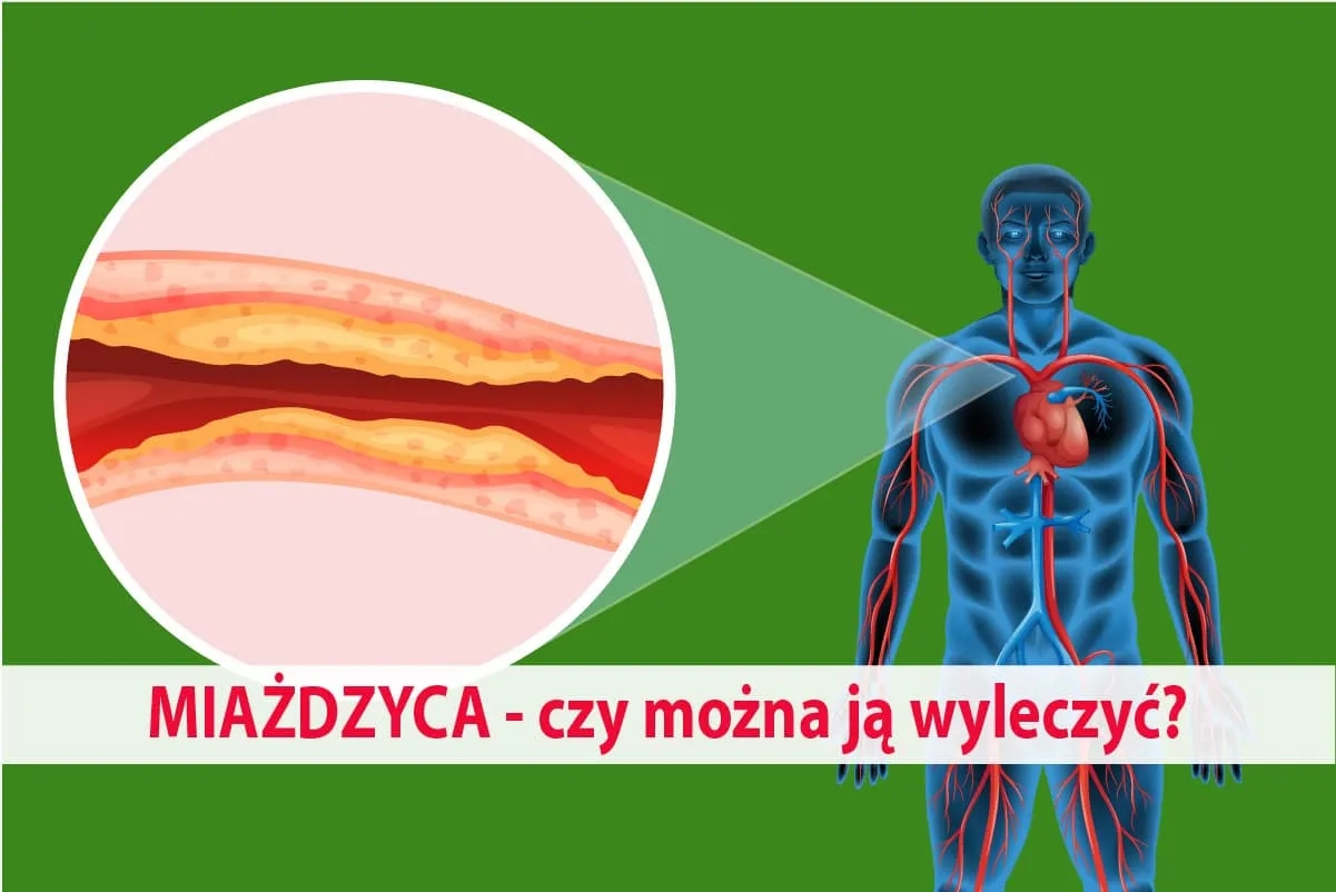 Jakie leki na miażdżycę mogą uratować Twoje serce i zdrowie?