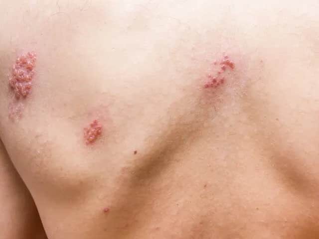 Jakie leki przeciwbólowe na półpasiec pomogą złagodzić ból?