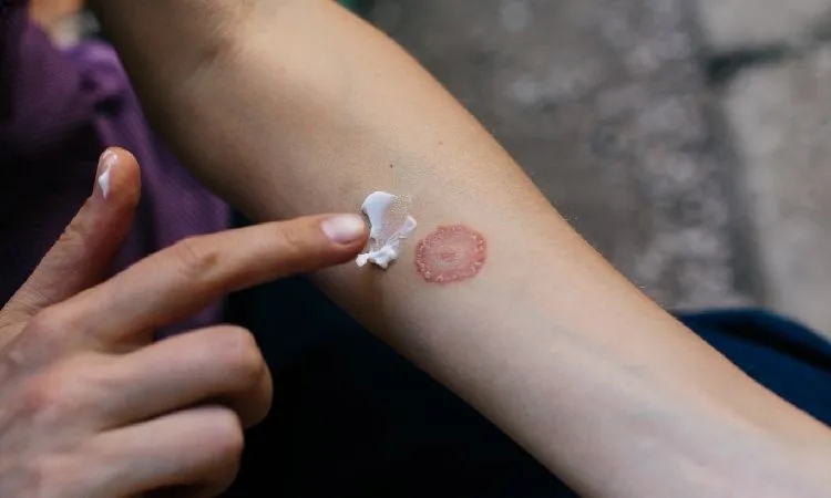 Jakie leki na grzybicę skóry pomogą Ci szybko i skutecznie?