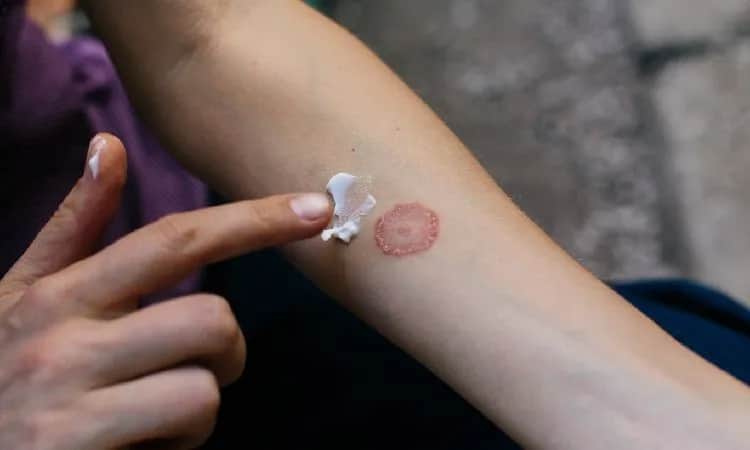 Jakie leki na grzybicę skóry pomogą Ci szybko i skutecznie?