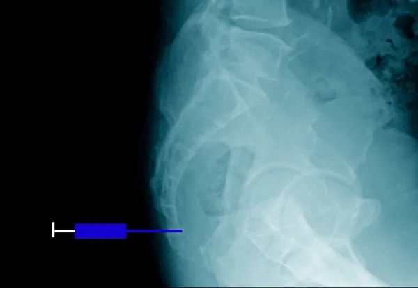 Jakie leki na ból kości ogonowej mogą naprawdę pomóc w ulgach?