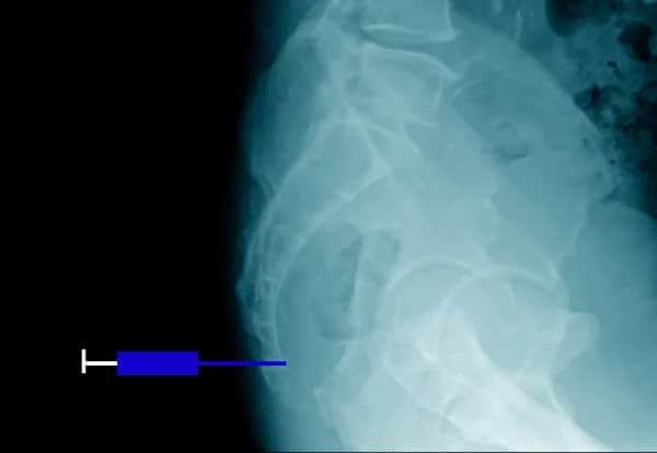 Jakie leki na ból kości ogonowej mogą naprawdę pomóc w ulgach?